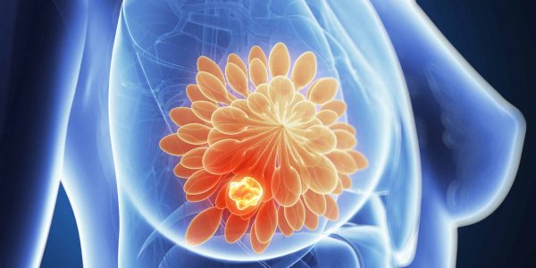 3d,Rendered,Illustration,-,Breast,Cancer